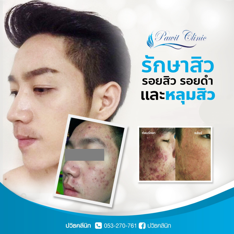 ปวิธ คลินิก เลเซอร์